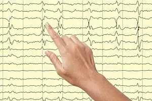 【Udemy中英字幕】Learn Essentials of Adult Electroencephalography (EEG)